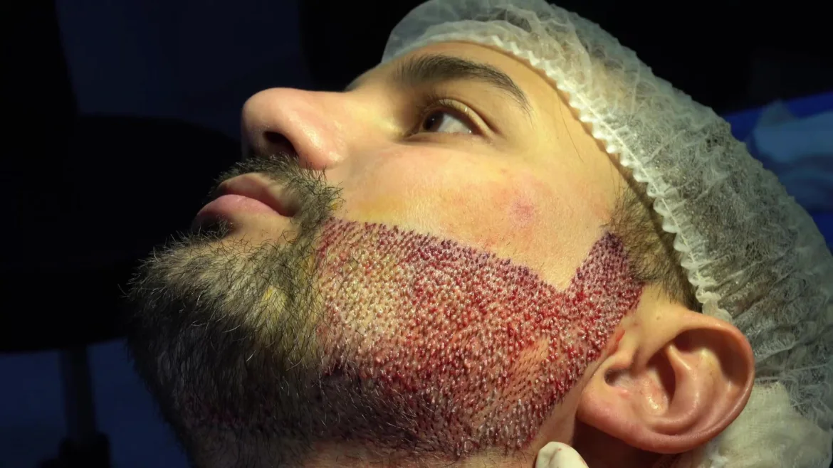 Beard Transplant